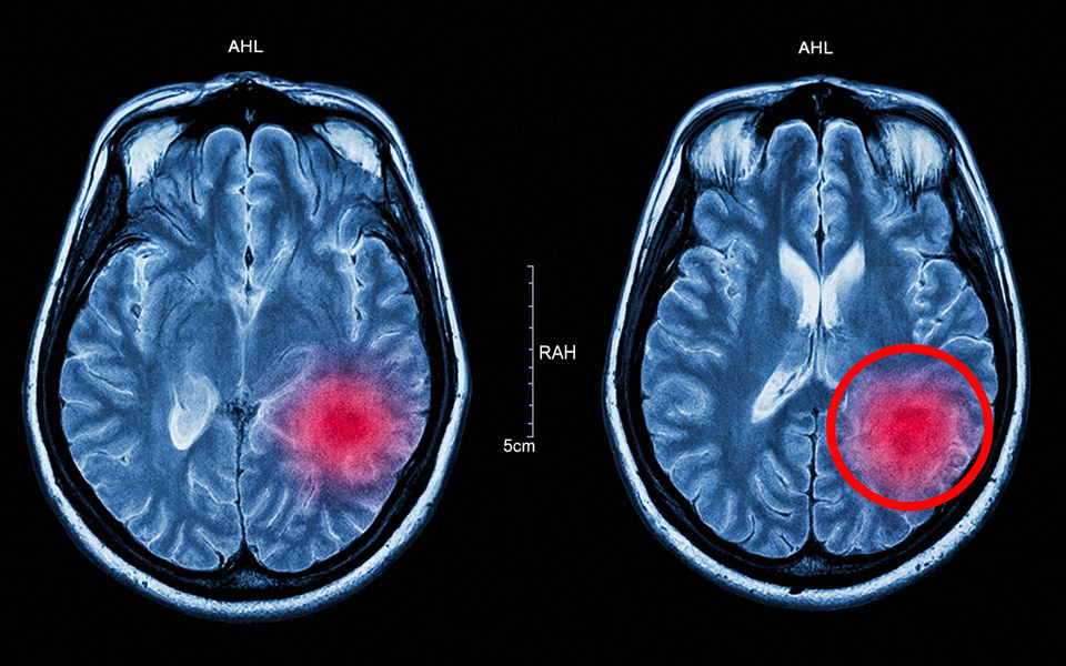 Big Pharma Terrified: Memory Loss Reversed Without Drugs or Pills