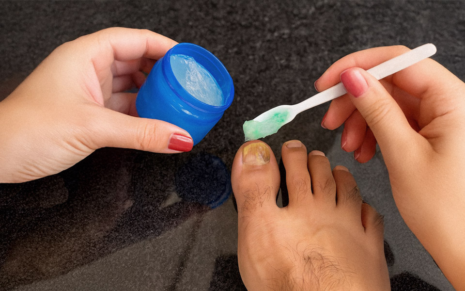 The "Fungal Fortress" That Blocks Treatment (And How to Break Through)